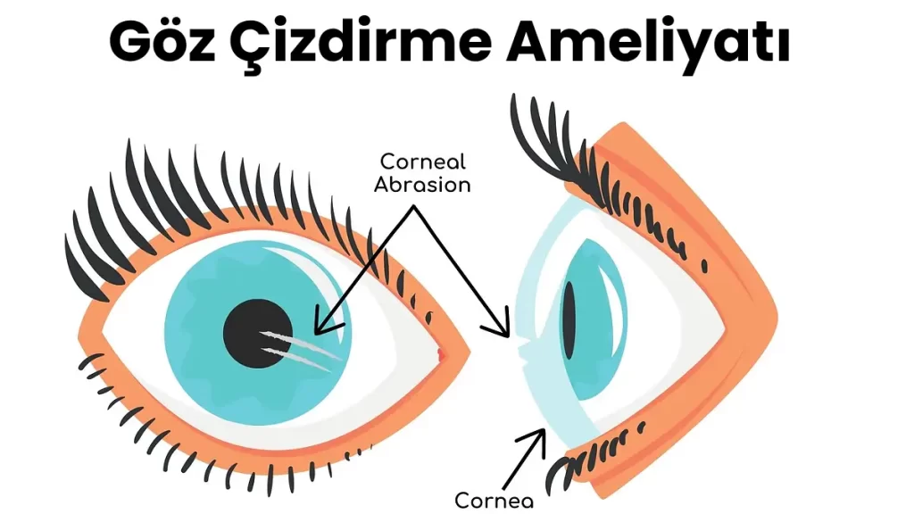 Göz Çizdirme Ameliyatı